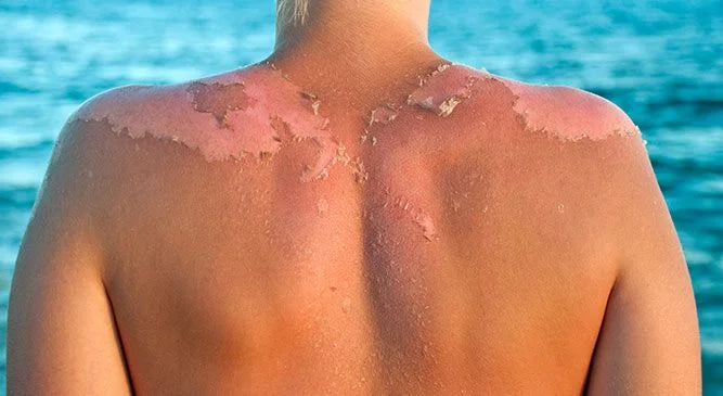 The 7 Best Natural Remedies for Sunburn Relief