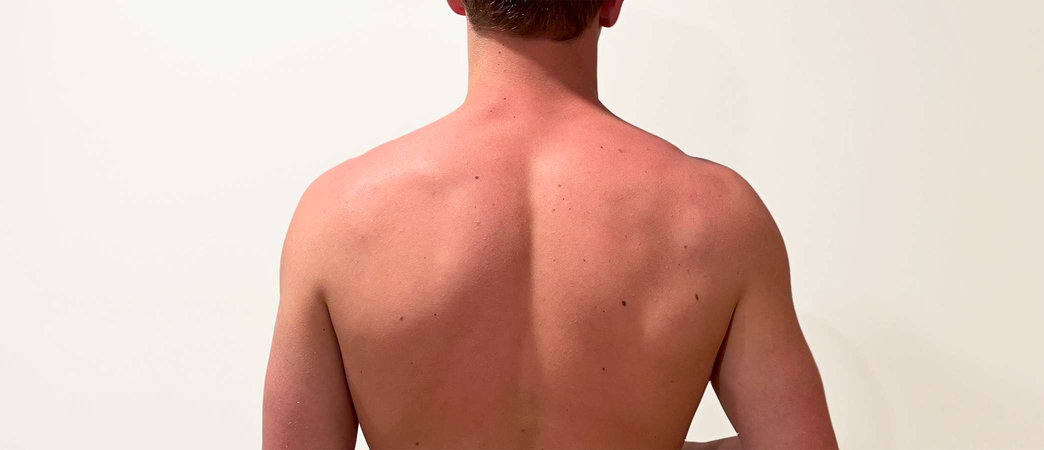 Young Man's Back 4 Hours After Sunburn