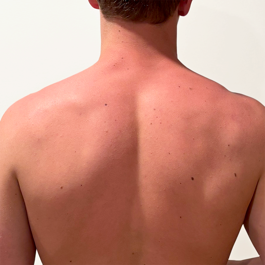 Young Man's Back 4 Hours After Sunburn